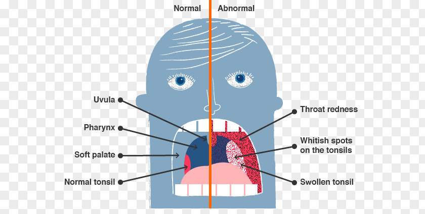 Rubythroated Hummingbird Streptococcal Pharyngitis Sore Throat Streptococcus PNG