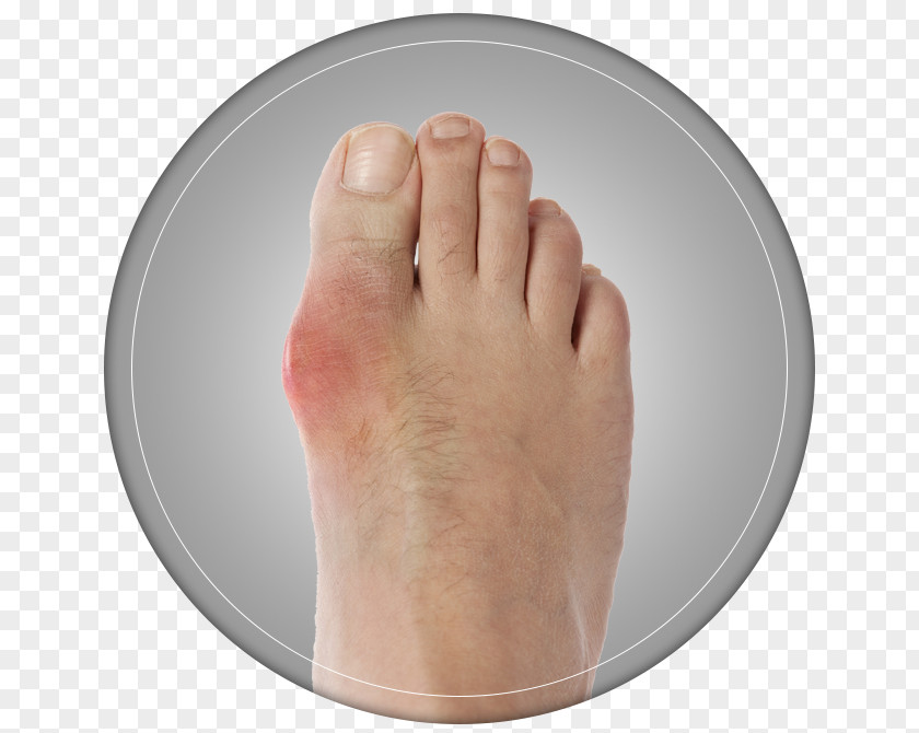 Gout Thumb Bunion Toe Hallux Shoe Size PNG