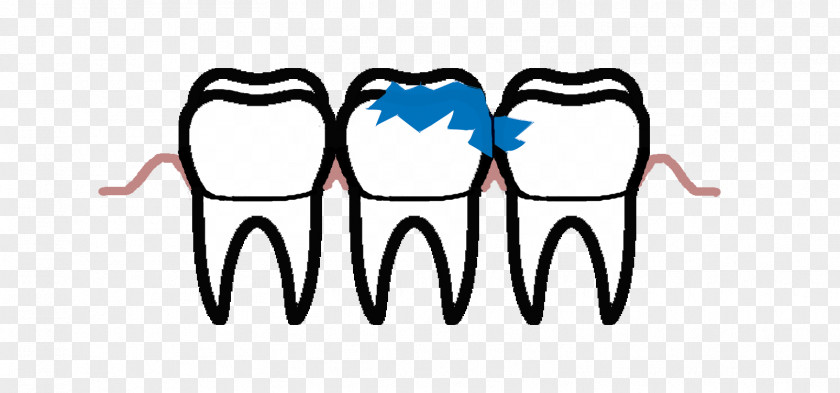 Tooth Decay Periodontal Disease Pulp Endodontics PNG