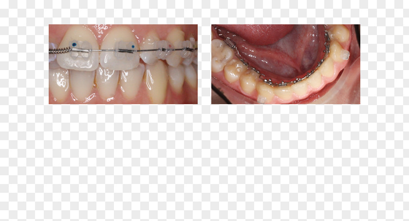 Dental Treatment Close-up PNG