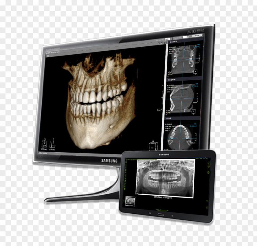 Effect Chart Of Dental Restoration Dentistry Computer Software VELscope Visualization Medical Diagnosis PNG