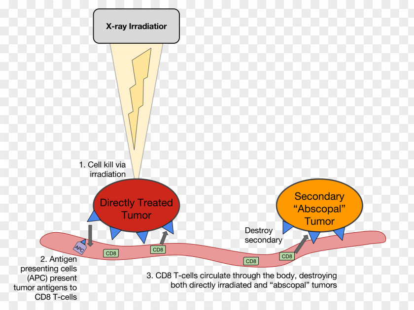 Therapy Abscopal Effect Cancer Metastasis Radiation Melanoma PNG