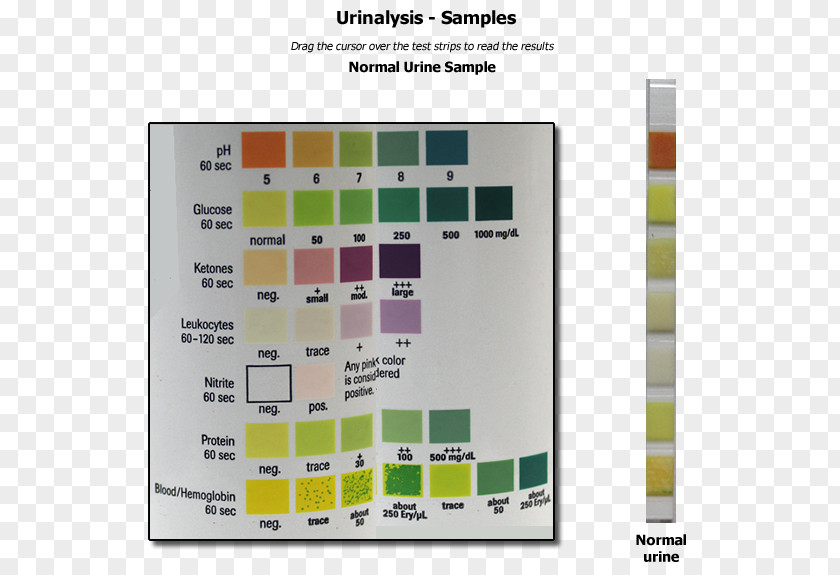 Anatomy Human & Physiology Clinical Urine Tests Test Strip Ketone Bodies PNG