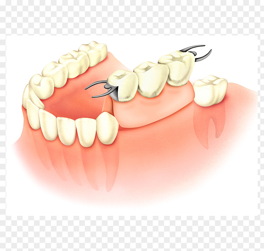 Bridge Tooth Dentures Dental Implant Prosthesis Dentistry PNG