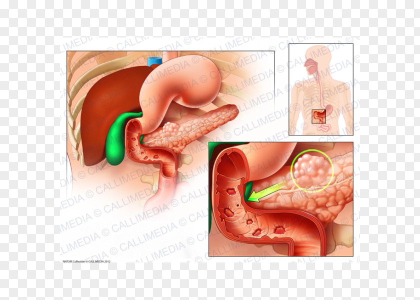 Zollinger–Ellison Syndrome Gastrinoma Peptic Ulcer Disease Symptom PNG