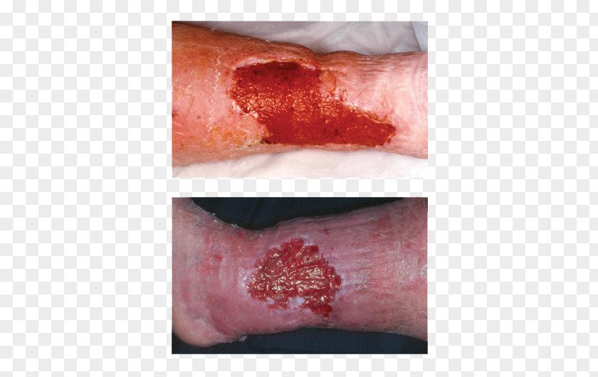 Wounds Wound Healing Inflammation Dressing PNG