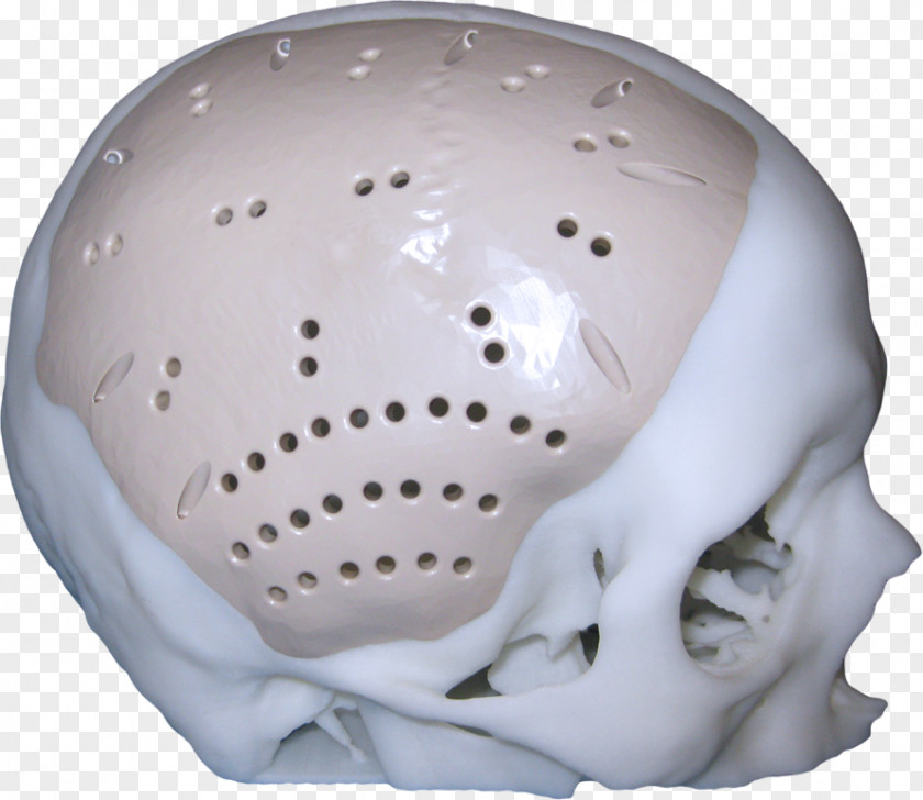 Skull Jaw Implant Cranioplasty Surgery PNG