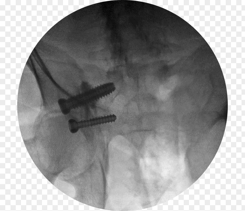 Bone Material Grafting Joint Implant PNG