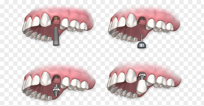 Crown Dental Implant Dentistry Dentures PNG