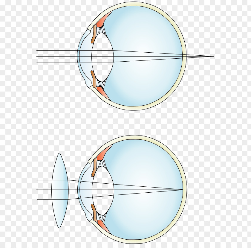 Eye Hypermetropia Near-sightedness Lens Glasses PNG