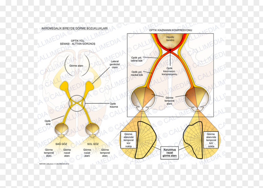 Acromegalia Acromegaly Paper Organism Nose Human Behavior PNG