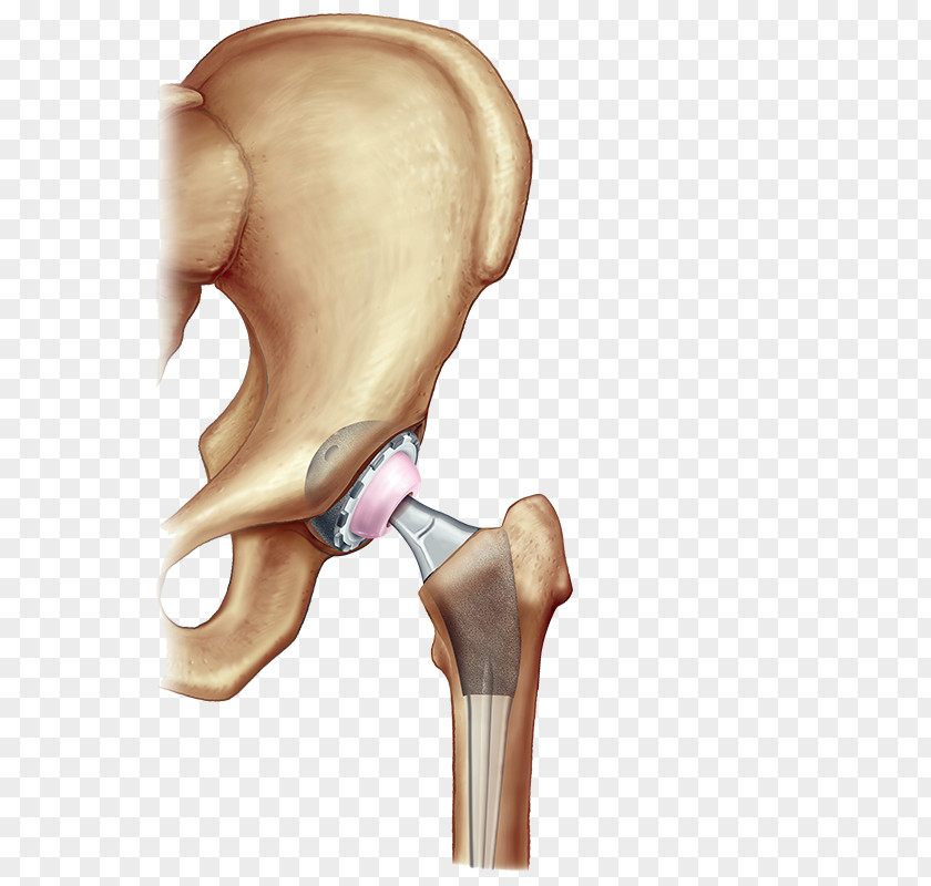 Hip Arthroscopy Replacement Surgery Knee Joint PNG