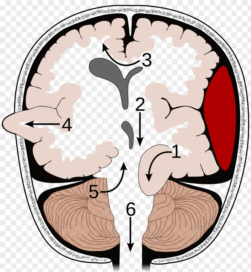 Brain Herniation Intracranial Pressure Tumor Uncus PNG