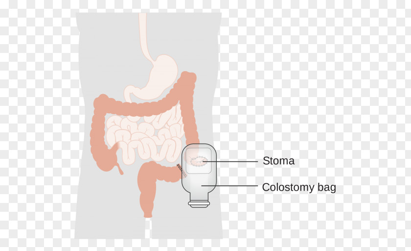 Hinh Nen Co Trang Colostomy Stoma Ileostomy Surgery Ostomy Pouching System PNG
