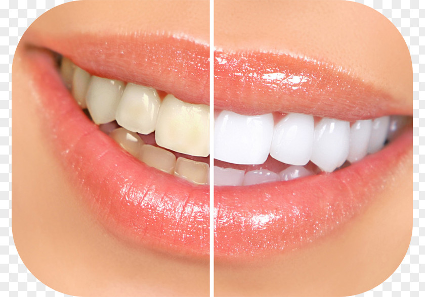 Tooth Whitening Dentistry Human PNG