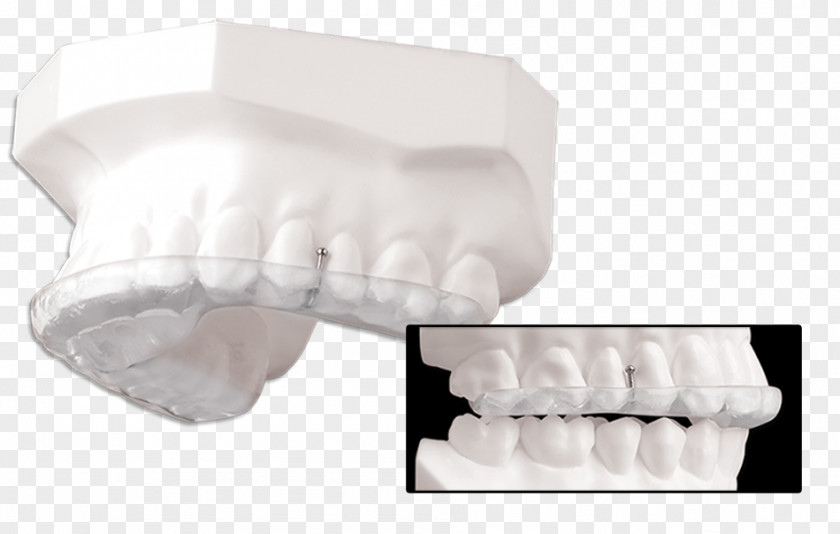 Mandibular Advancement Splints Splint Tooth Temporomandibular Joint Dysfunction Therapy Image PNG