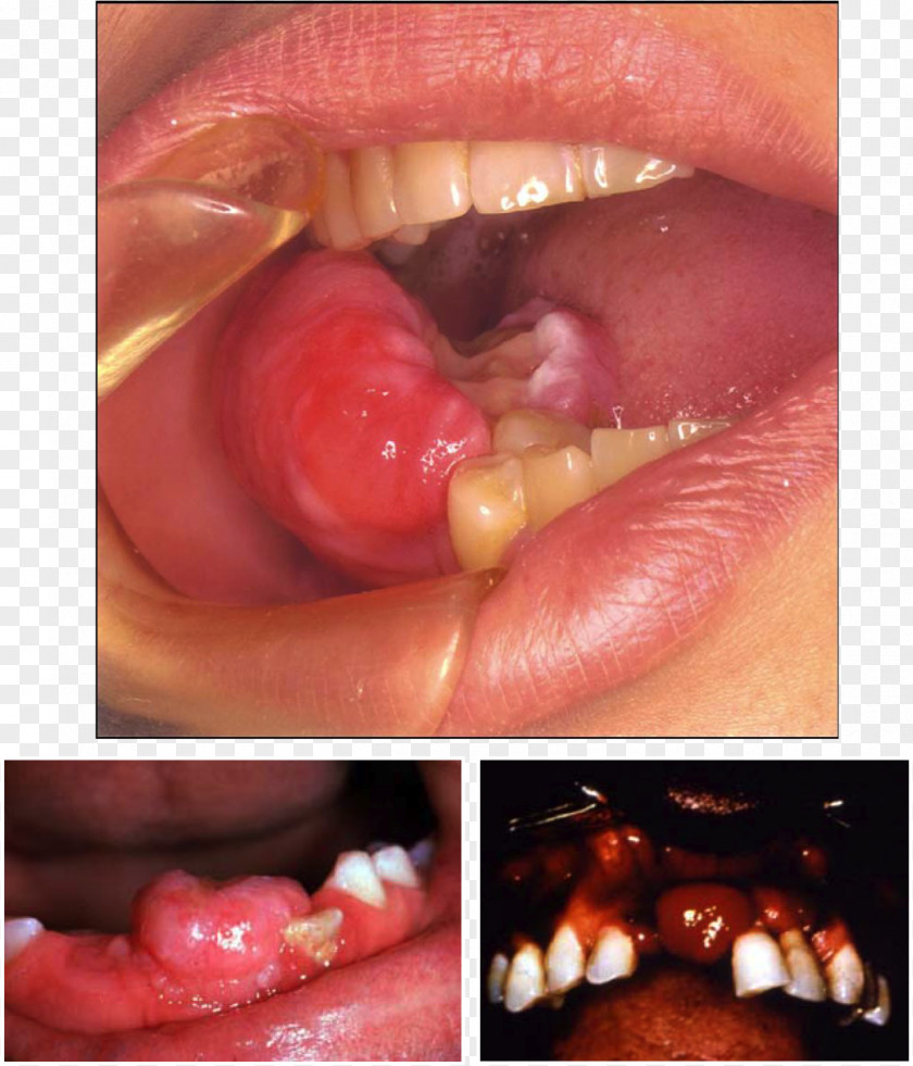 Dermitek Odontogenic Cyst Peripheral Fibroma Ossifying PNG
