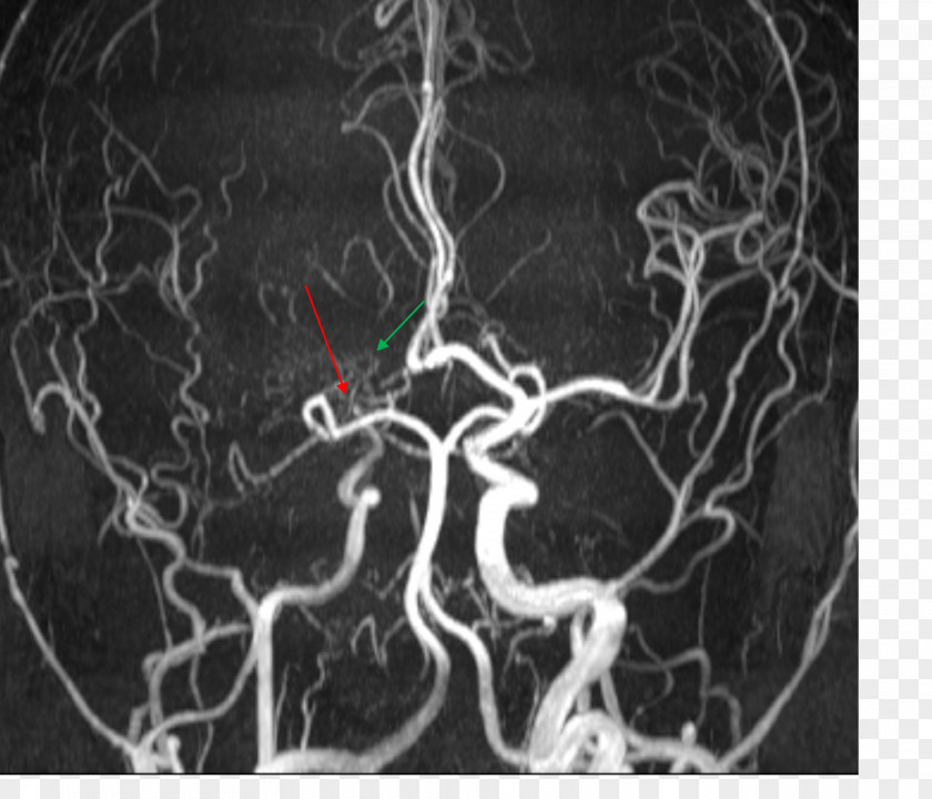Posterior Cerebral Artery Medical Imaging Magnetic Resonance Angiography Moyamoya Disease PNG