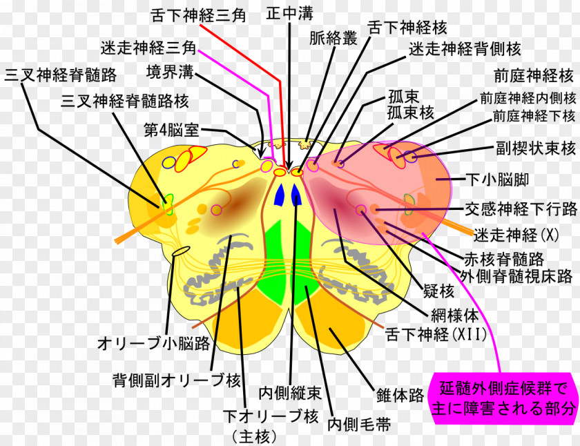 Lateral Medullary Syndrome Medulla Oblongata Posterior Inferior Cerebellar Artery Cerebellum PNG