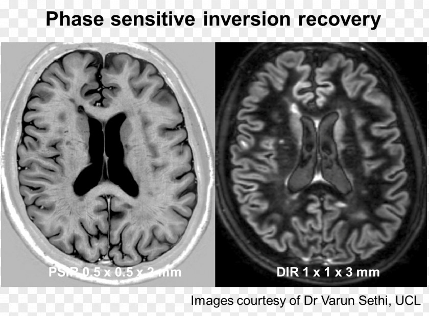 Multiple Sclerosis Brain Grey Matter White Gray Heterotopia Lesion PNG