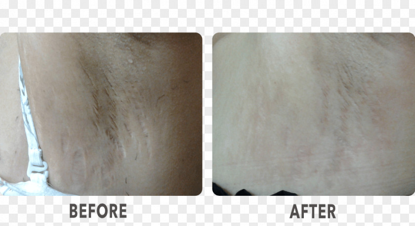 Wood La Skinnovita- Dr. Anuj Pall Dermatology, Laser & Hair Centre Material Scar PNG