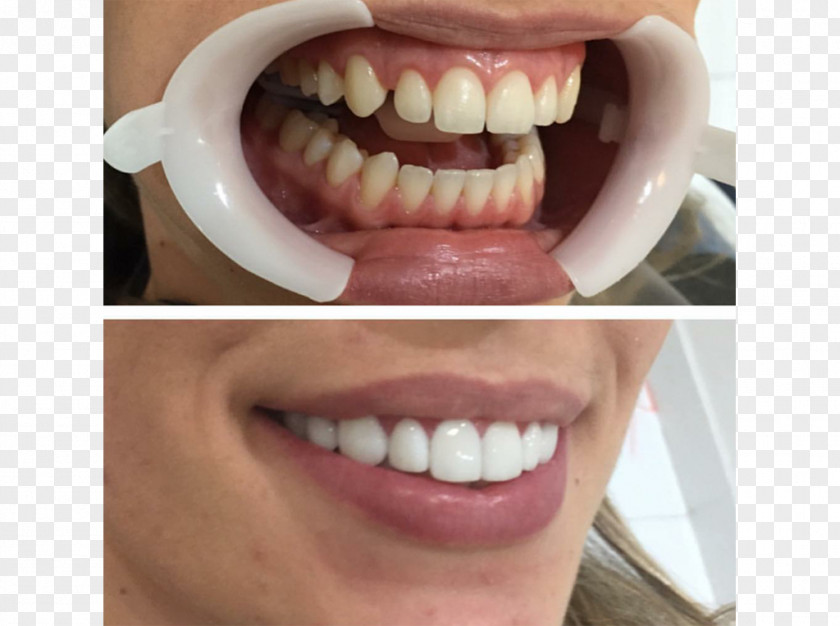 Crown Tooth Whitening Veneer Dentist Dental Implant PNG