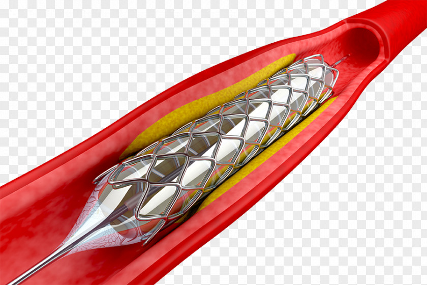 Heart Angioplasty Percutaneous Coronary Intervention Stenting Stent Balloon Catheter PNG