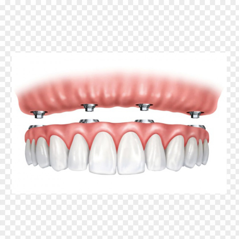 All-on-4 Dental Implant Dentures Dentistry PNG