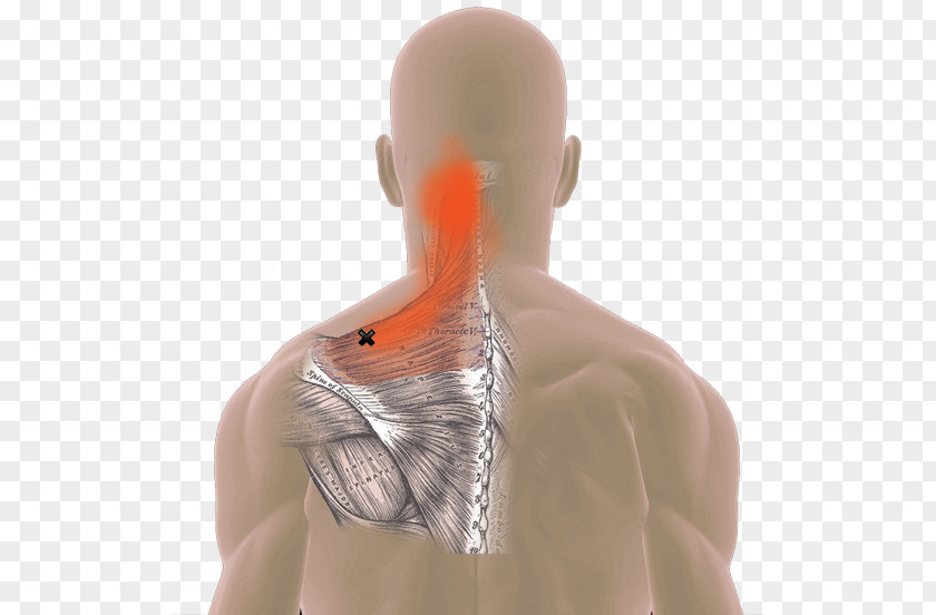 Headache Neck Pain Myofascial Trigger Point Trapezius Muscle Spasm PNG