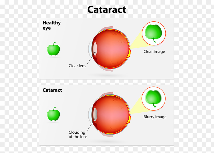 Eye Cataract Surgery Intraocular Lens Human PNG