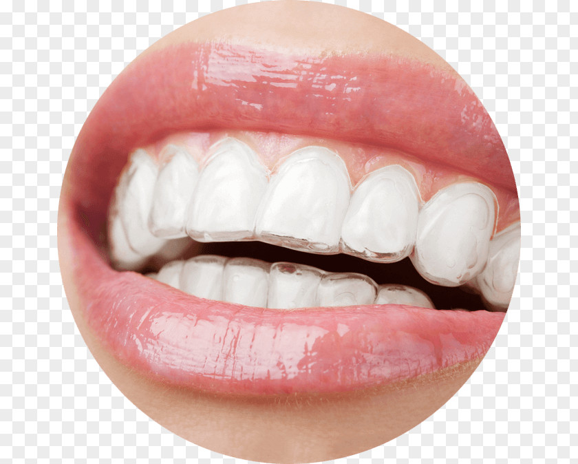 Braces Clear Aligners Dental Orthodontics Dentistry PNG