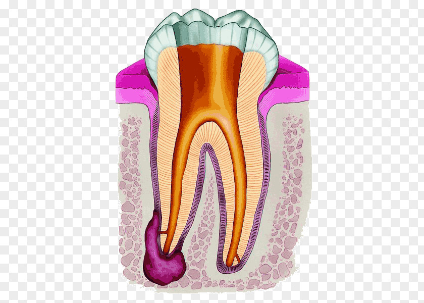 Crown Endodontic Therapy Root Canal Endodontics Dentistry PNG