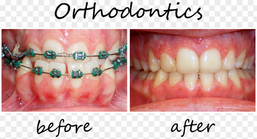 Crown Tooth Orthodontics Dentistry Veneer Dental Implant PNG