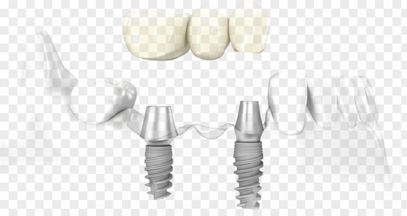Bridge Dental Implant Dentistry PNG