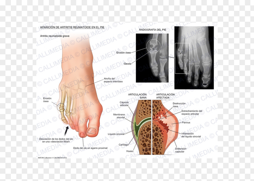 Rheumatoid Arthritis Foot Thumb Rheumatology PNG