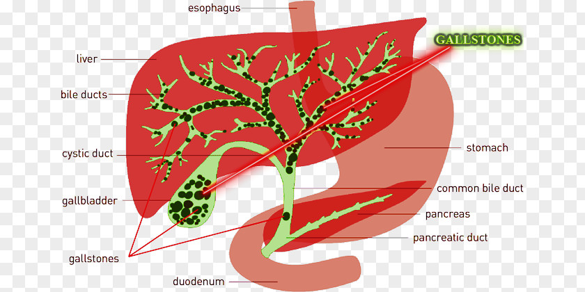 Gallbladder Pain The Liver And Miracle Cleanse Flush Gallstone PNG