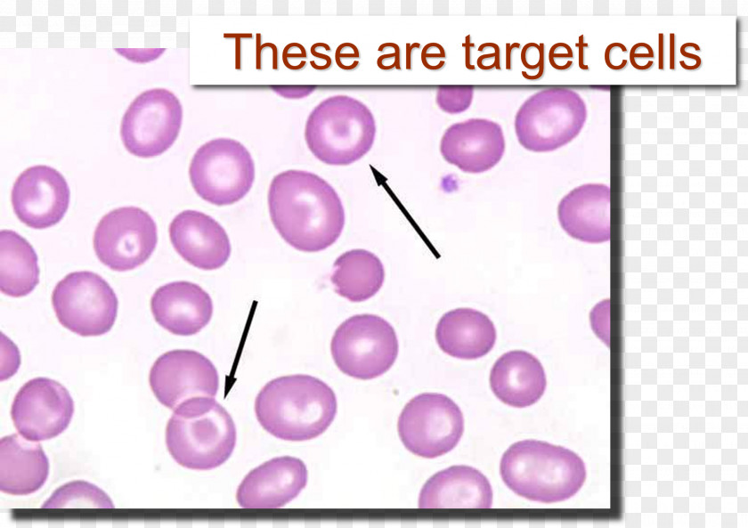 Cavernous Cell Codocyte Red Blood Film Poikilocytosis PNG