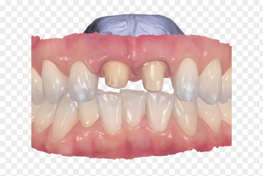 Crown Tooth Dentistry Fingerprint PNG