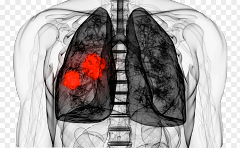 Lung Cancer Disease Therapy PNG