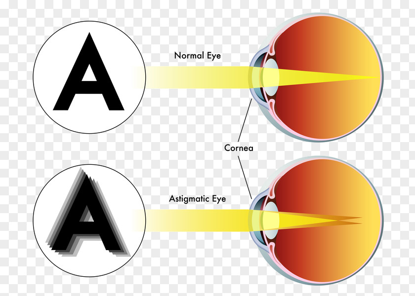 Myopia LASIK Astigmatism Refractive Surgery Eye PNG