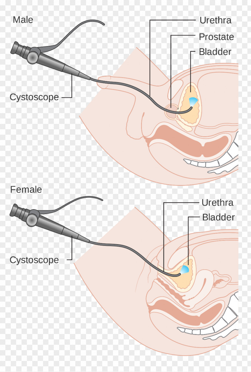 Cystoscopy Ureteroscopy Endoscopy Medical Procedure Surgery PNG