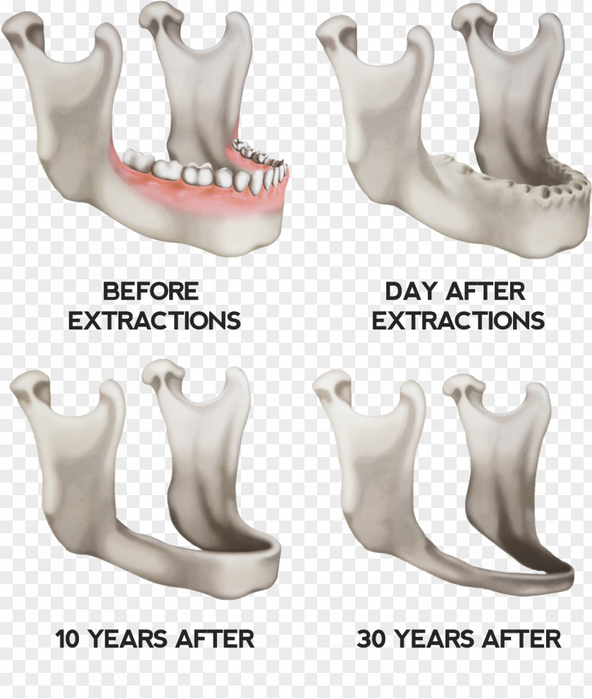 Dentures Jaw Dental Implant Tooth PNG