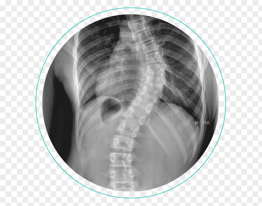 Rib Cage Scoliosis X-ray Vertebral Column Physical Therapy Cobb Angle PNG