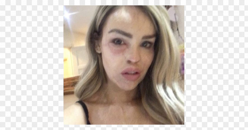 Model Katie Piper Acid Throwing Disfigurement PNG