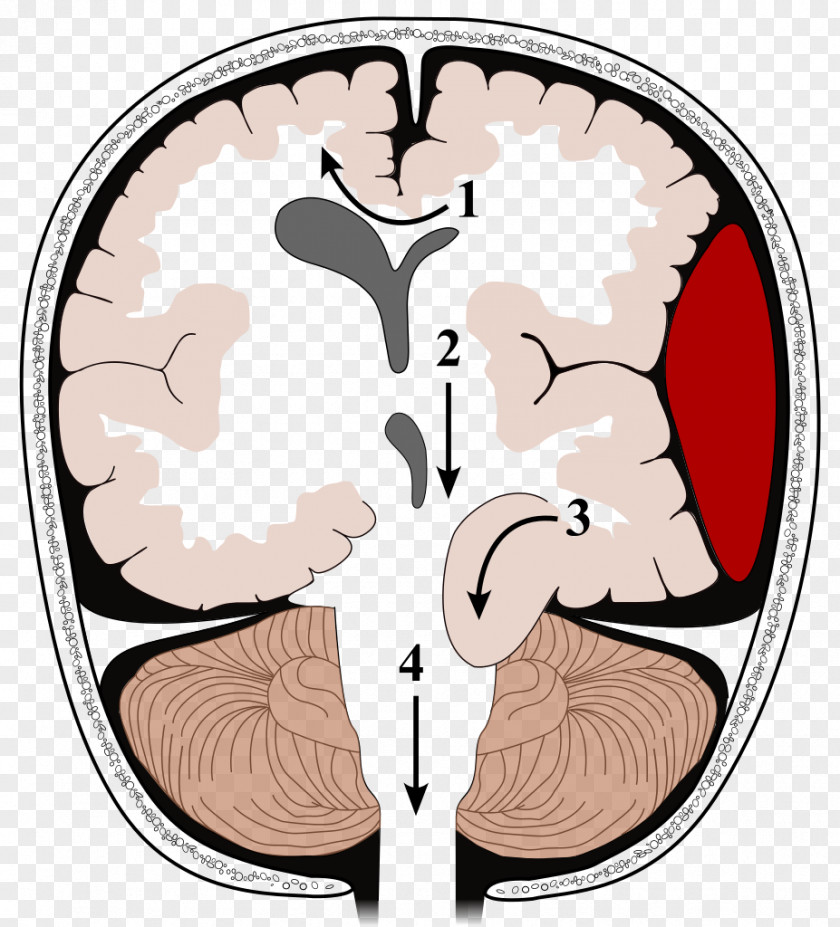 Brain Herniation Intracranial Pressure Traumatic Injury Kernohan's Notch PNG