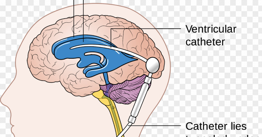 Cerebral Shunt Endoscopic Third Ventriculostomy Hydrocephalus Cerebrospinal Fluid PNG