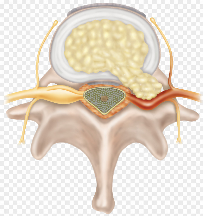 Lining Spinal Disc Herniation Vertebral Column Intervertebral Cervical Vertebrae Nerve Root PNG