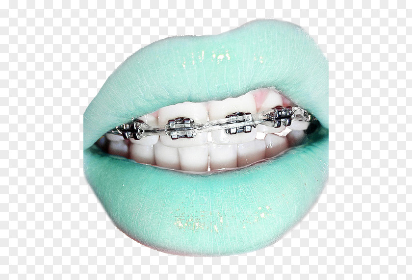 Brace Dental Braces Clear Aligners Lip Retainer Tooth PNG