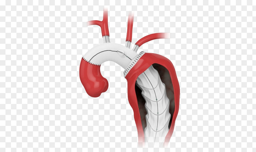 Aorta Prosthesis Endovascular Aneurysm Repair Stenting Surgery PNG