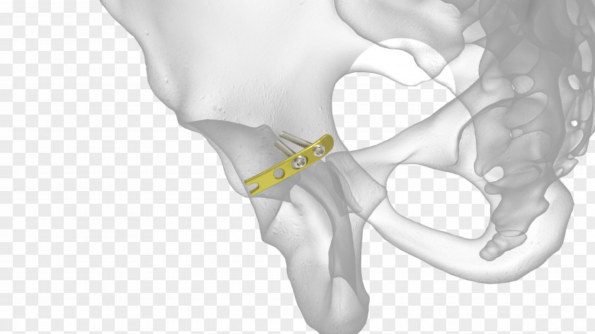 Bone Fracture Acetabulum Acetabular Radius Pelvic PNG
